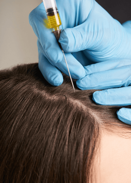 PRP Hair Treatment